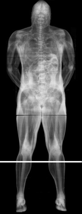 Artefact : Effet indésirable, parasite